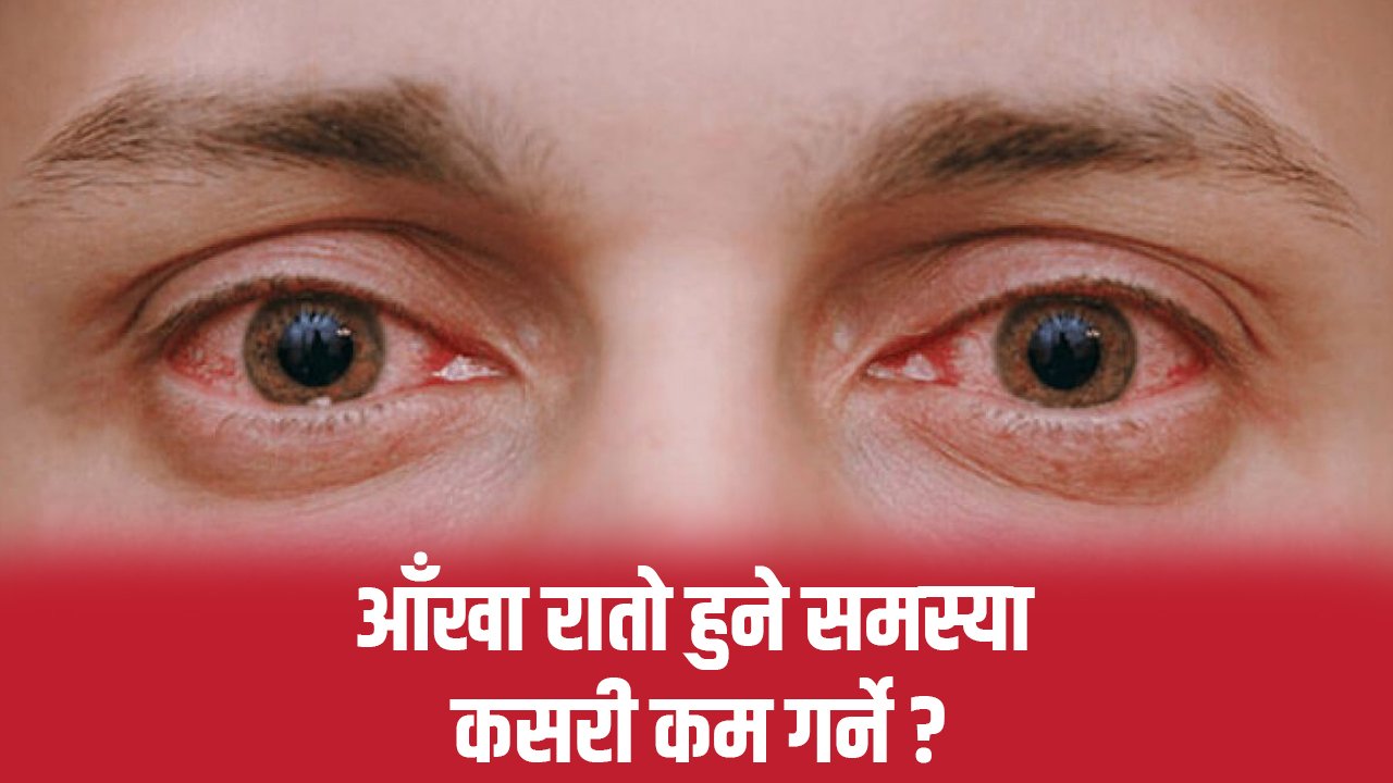 गर्मीयाममा तपाईंको पनि आँखा रातो हुने समस्या छ ?