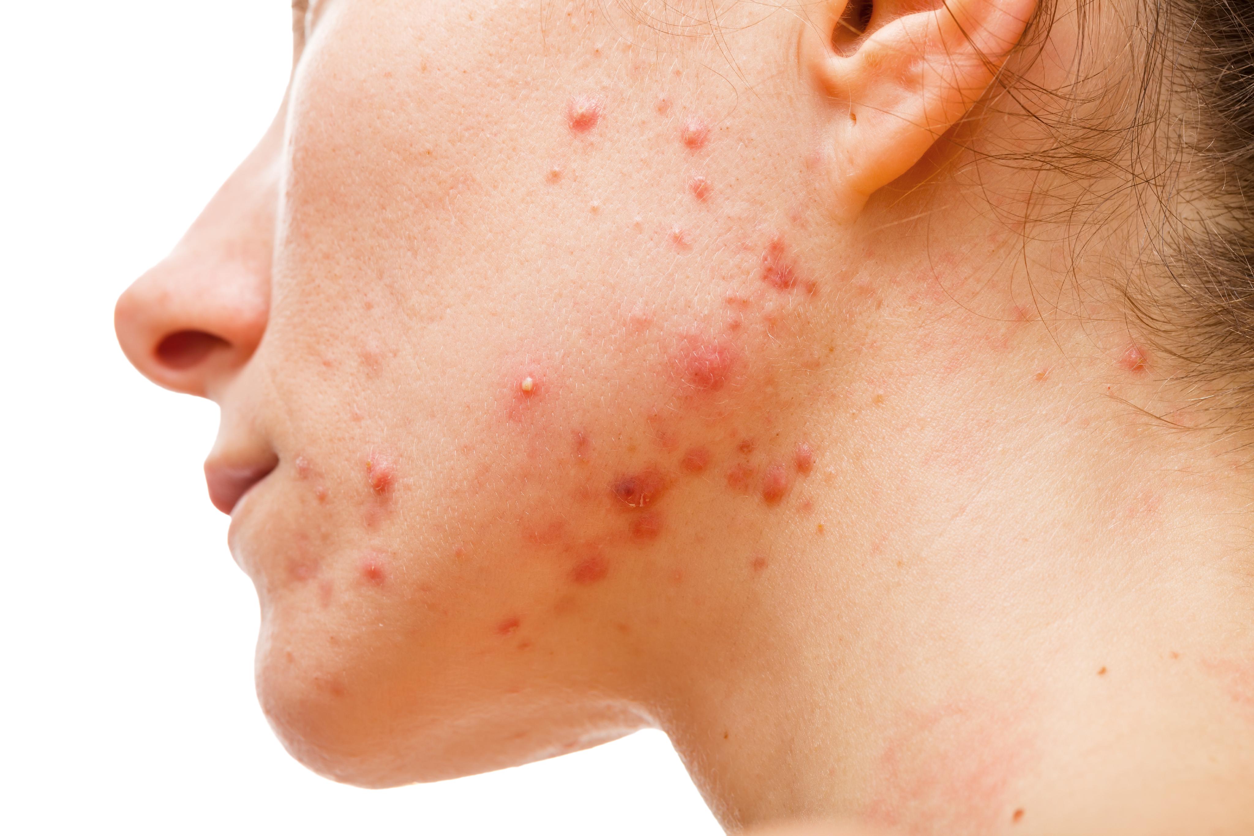 Acne_share