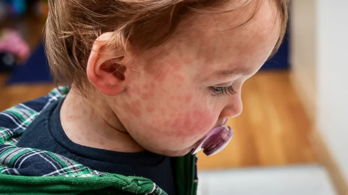 baby-with-rash-1296x728-header