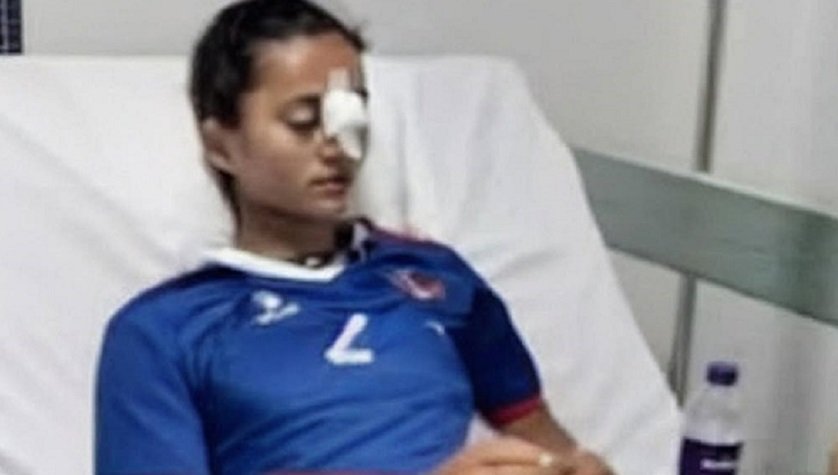 Nepali Footballer Bimala BK Undergoes Nasal Bone Surgery After Injury