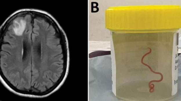 विश्वमा पहिलो पटक अजिङ्गरमा पाइने किरा मानिसको मस्तिष्कमा जिउँदै भेटियो