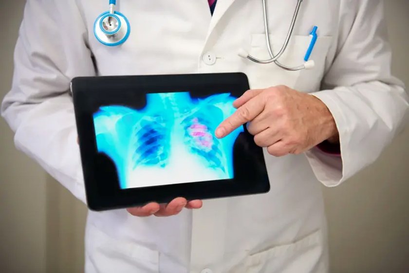 Breast-cancer