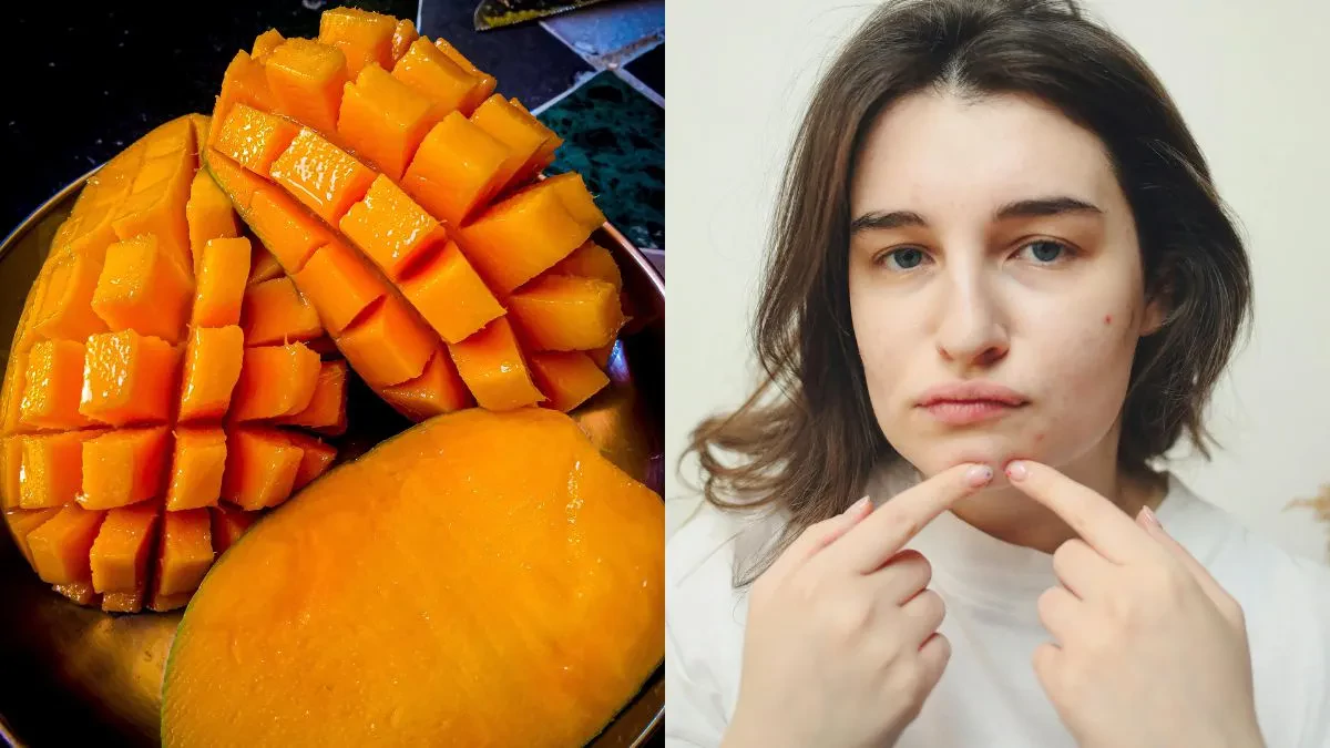 Mangoes and Pimples: Dermatologist Clarifies Connection