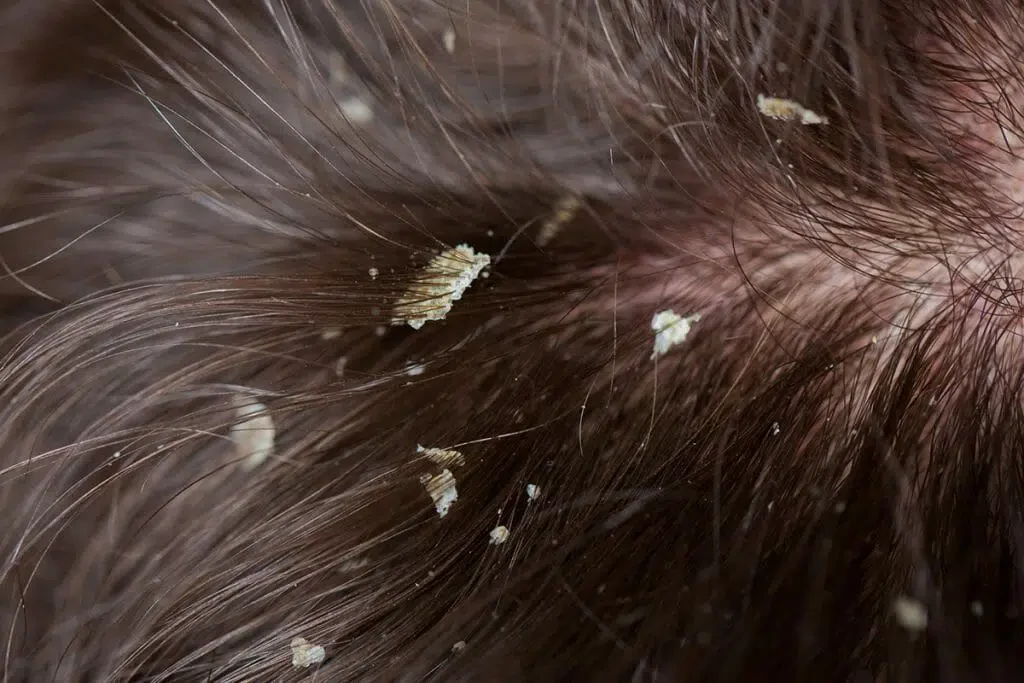 Dandruff-Photo-1024x683-1