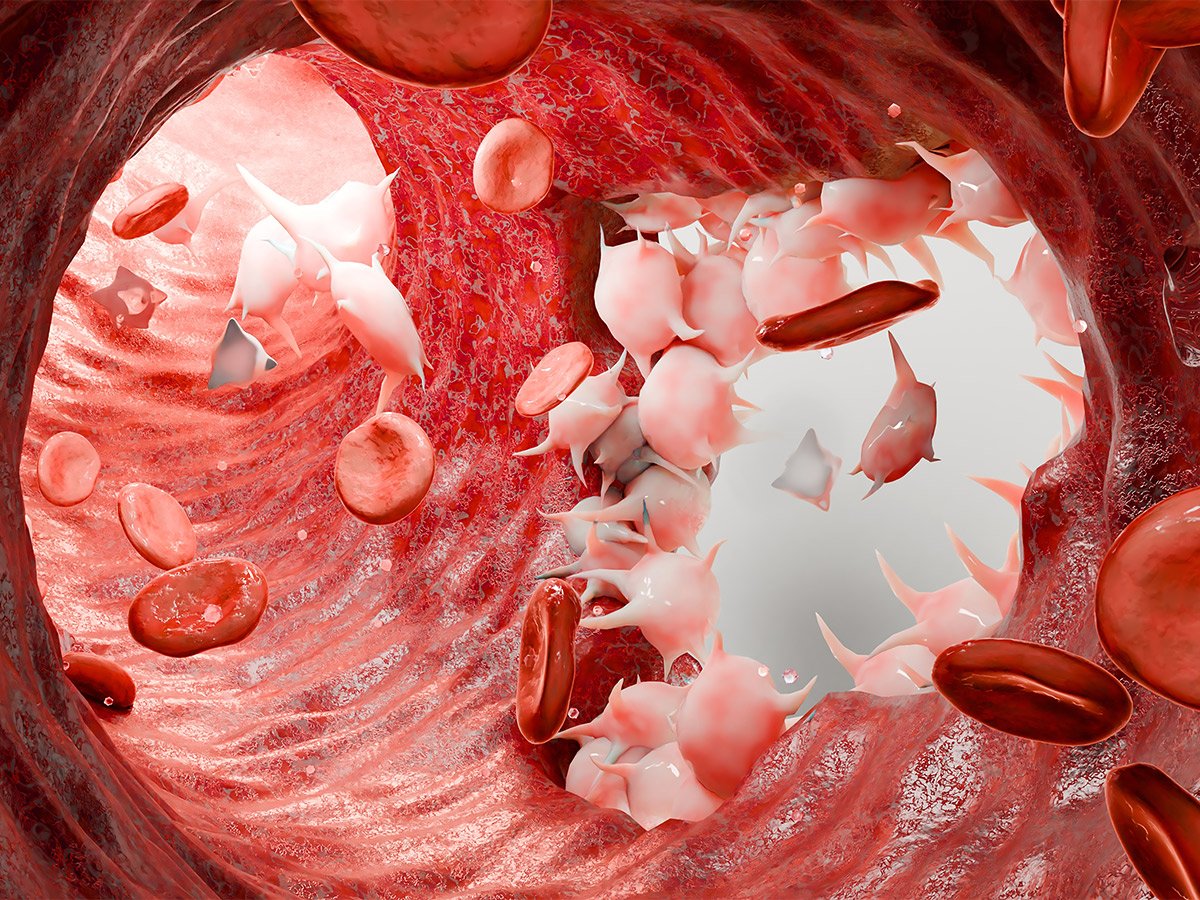 hemophilia 2