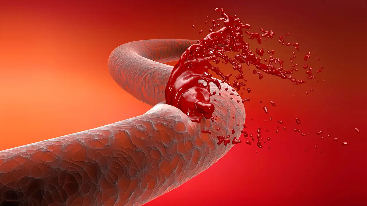 hemophilia 3
