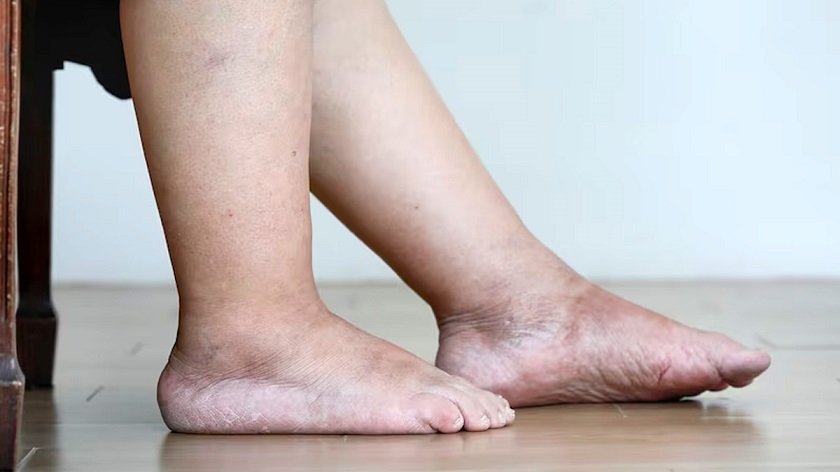 फ्याटी लिभर छ ? खुट्टामा देखिन्छ पहिलो लक्षण