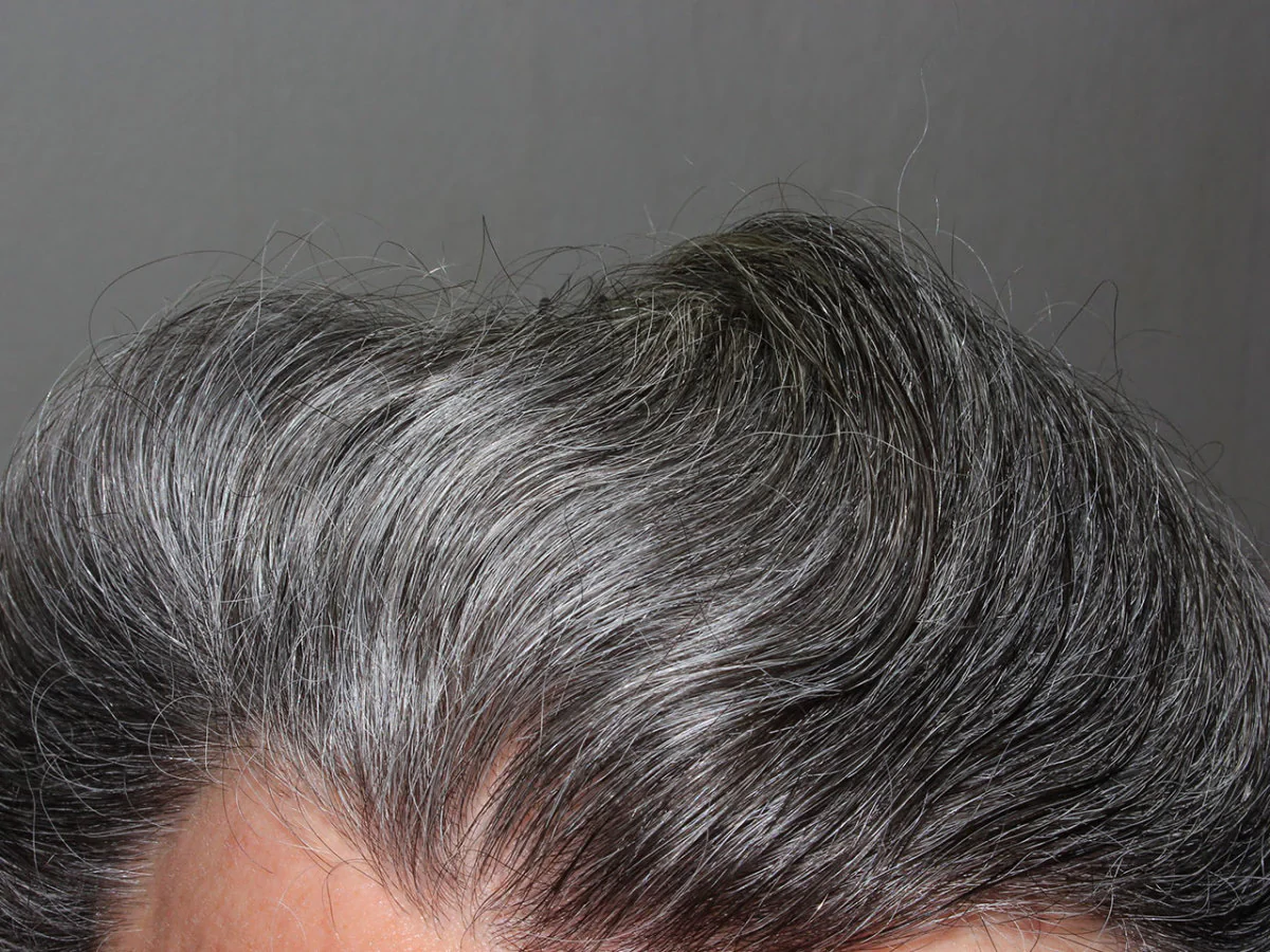 premature greying 2