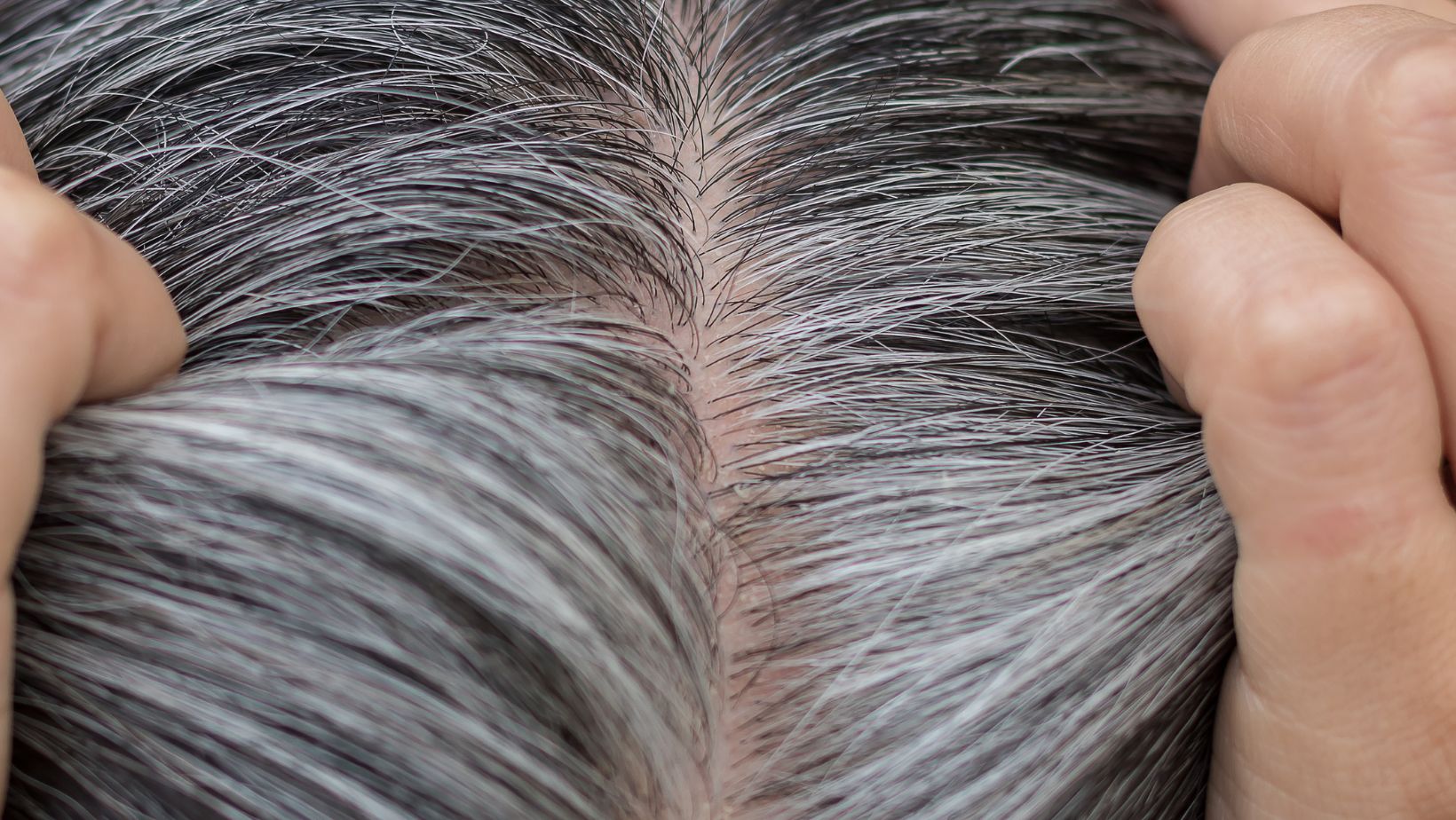 premature greying 3
