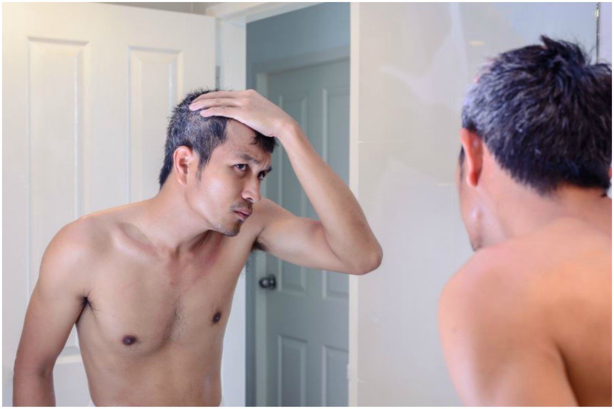 premature greying