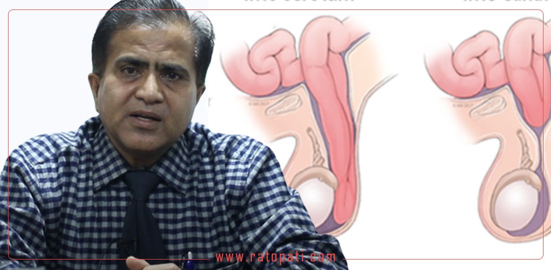   बच्चाको अण्डकोषमा यस्तो समस्या भए गर्नुपर्छ शल्यक्रिया (भिडियो)