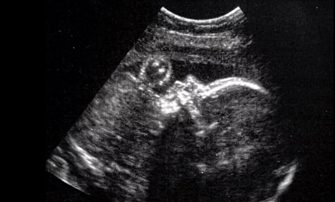 पहिलो पटक गर्भमा गरियो भ्रूणको मस्तिष्कको शल्यक्रिया