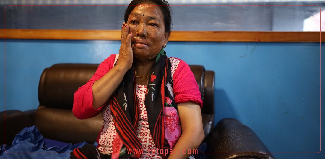आगोमा जलेर हात गुमाएकी सुकुमबासी उर्मिला तामाङका दुःख (भिडियो)