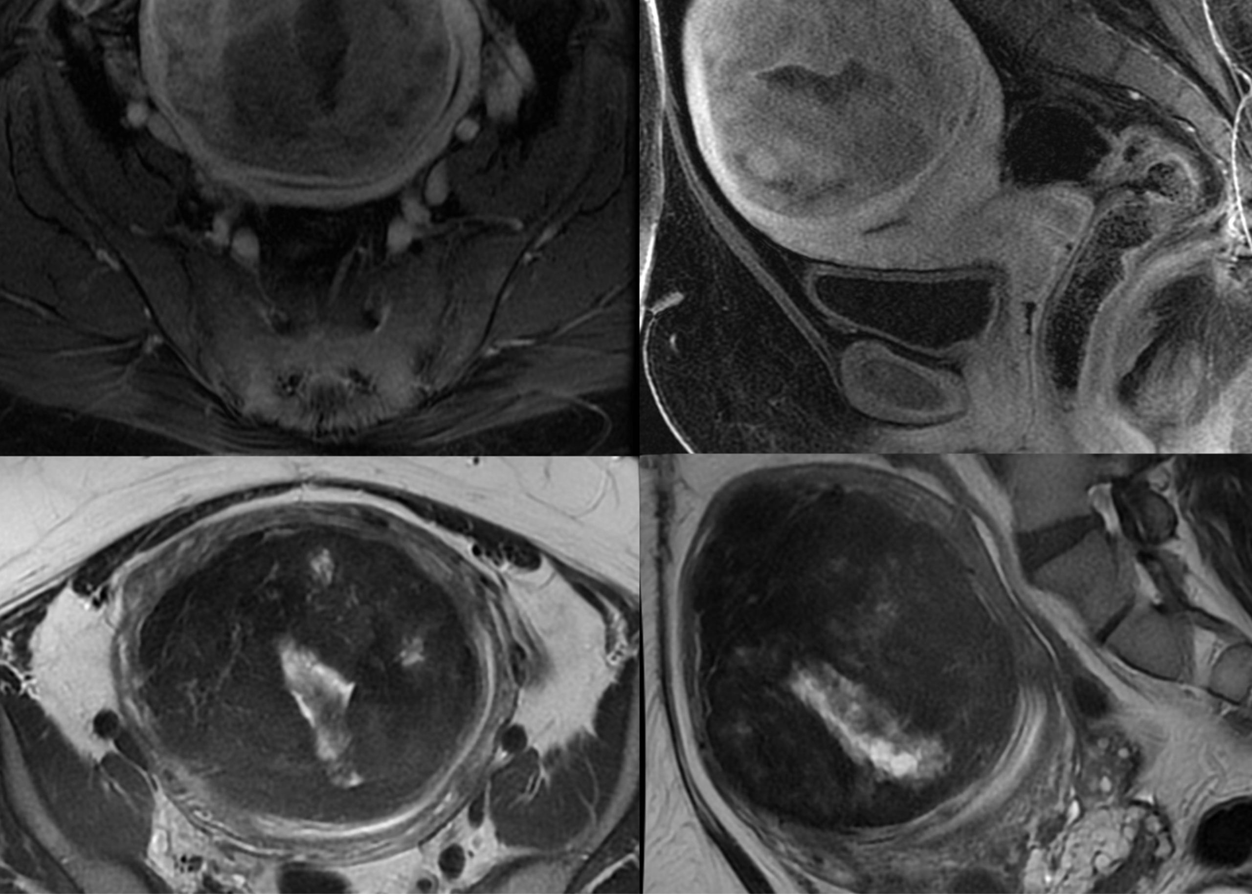 Uterine-Fibroids