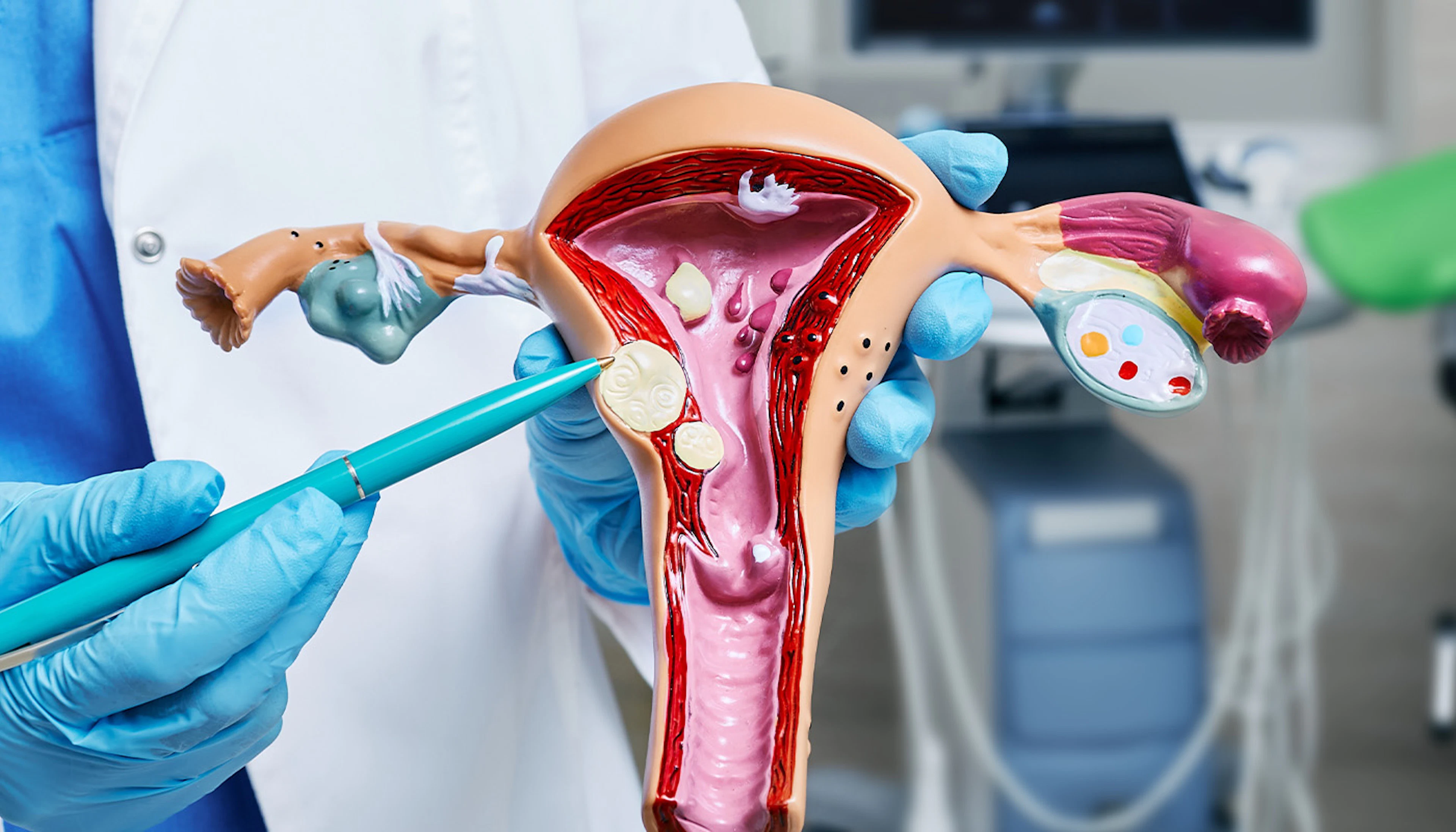 uterinefibroids