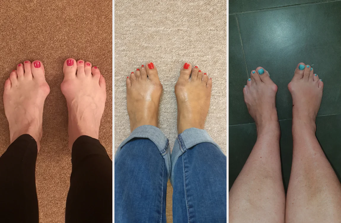 why_do_you_get_bunions